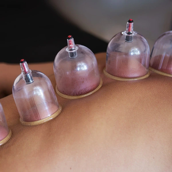 A row of cupping jars in use along a patient's back