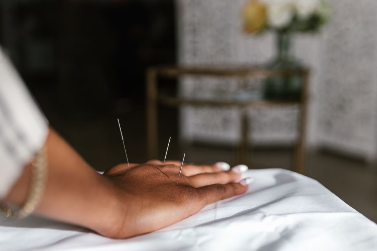 Acupuncture treatment in progress at Aujaswa Wellness Center