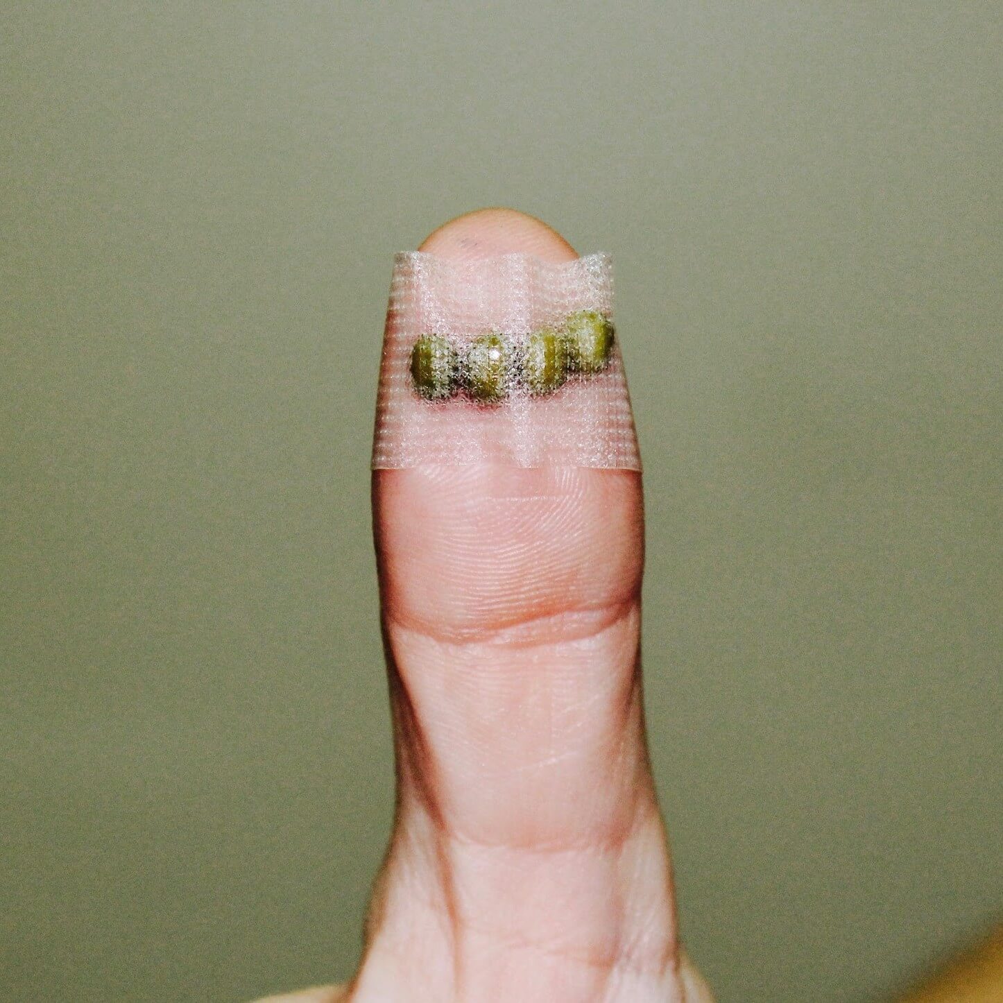 Seed therapy seeds taped onto a finger acupoint, close-up